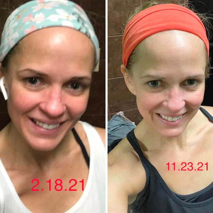 Patient smiling at camera wearing headband, before and after breast implant removal, dated 2.18.21 and 11.23.21